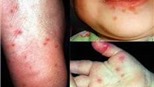 TP.HCM: Số ca mắc bệnh tay - chân - miệng giảm